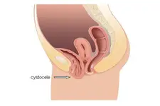 Vajina İçinde Şişlik Belirtileri ve Tedavisi