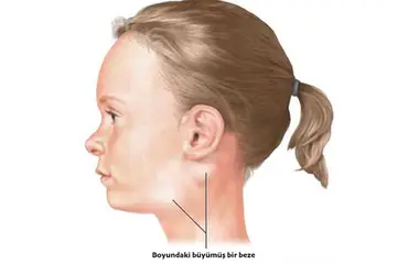 Çocuğun Boğazında Şişlik Belirtileri ve Tedavisi