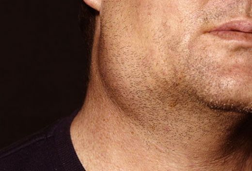 Boğazın Sağ Tarafında Şişlik Belirtileri ve Tedavisi